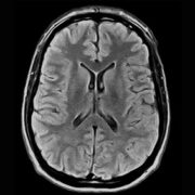 Magnofico csm_brain-FLAIR-axial_10_565f442884