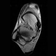 csm_ankle-FSET2-axial_10_4b18a63733